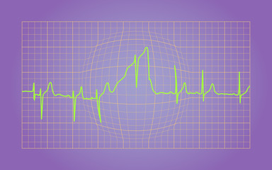 EKG of Healthy Heart