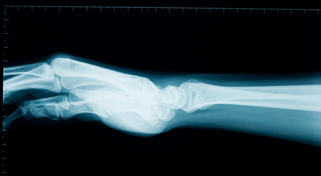 Hand wrist x-ray