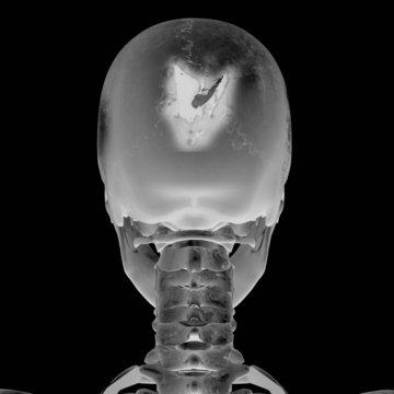 Röntgenbild mit Schädelverletzung (3D Render)