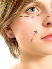 Face marked for cosmetic surgery