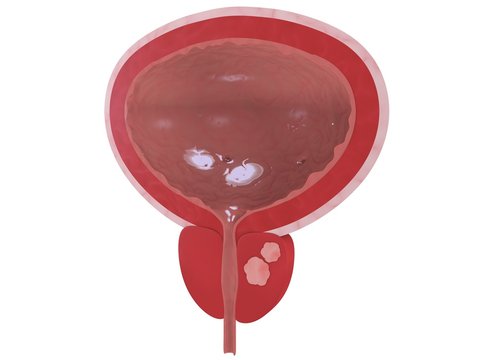 prostata - krebs
