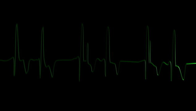 Electrocardiogram