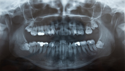 X-Ray of problematic wisdom teeth for extraction
