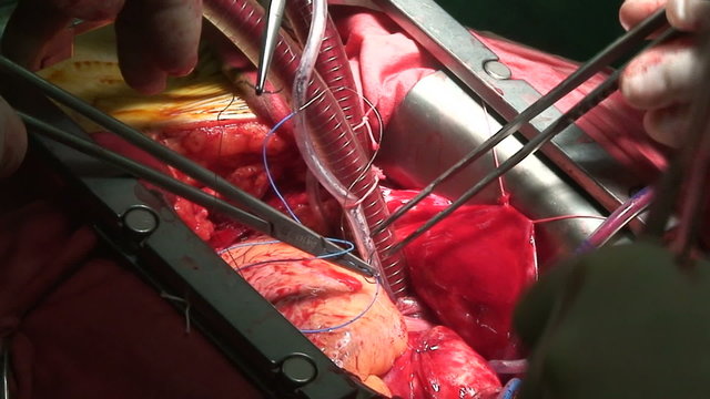 Cardiac surgery. Pacemaker electrodes implantation.