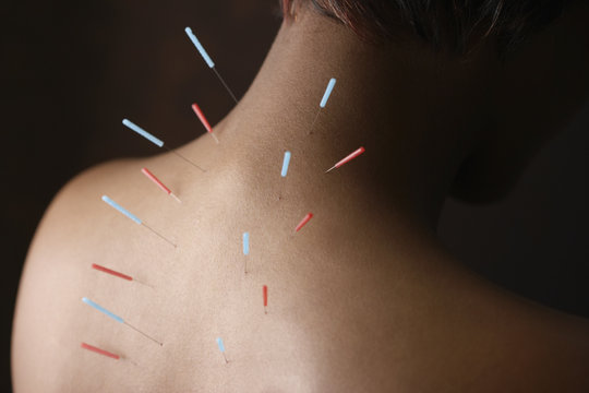 Acupuncture needles in African woman's back