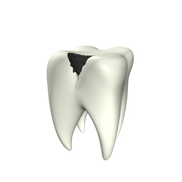 Caries Tooth 3D