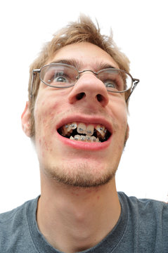 Man smiling showing his braces