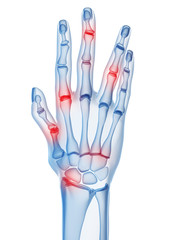 markierte arthritische Fingergelenke