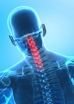 Pain in cervical spine concept x-ray view