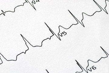 A macro picture of the EKG chart