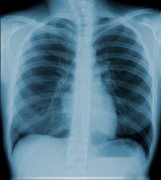 Radiographie pulmonaire de face