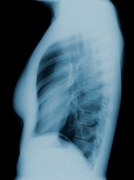 Radiographie pulmonaire de profil