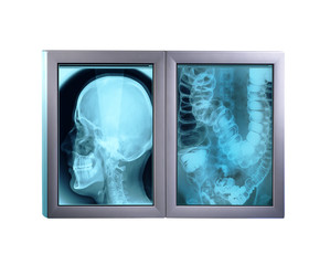 Double x-ray minitor,isolated
