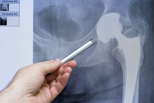 eine H&uuml;fttotalendoprothese wird am R&ouml;ntgenschirm demonstriert