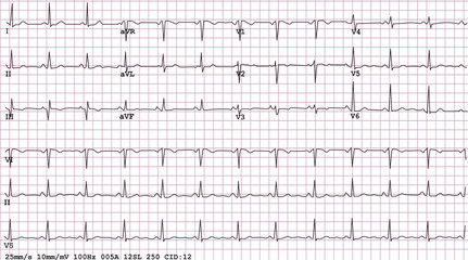 Example of a normal 12-lead sinus rhythm ECG - 19691722