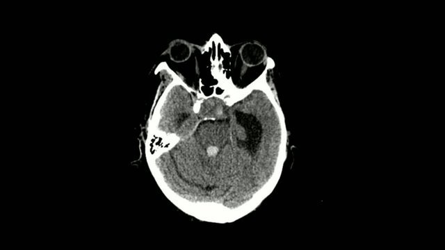 scanner cérébral hémoragie