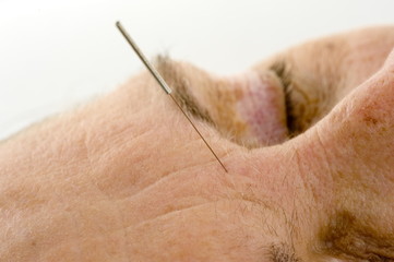 Acupuncture