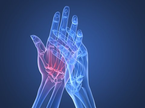 Schmerzen in der Hand - Röntgenillustration