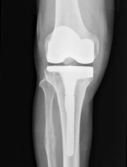 Artificial Knee x-ray of total knee arthroplasty