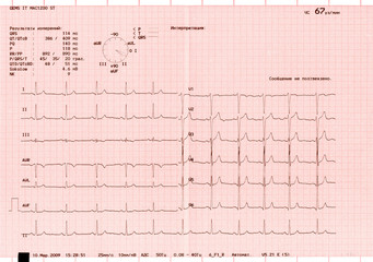 The graphs of an electrocardiogram