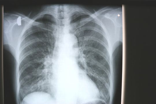 X-ray of human chest