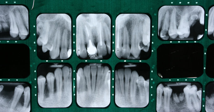 Dental X-ray