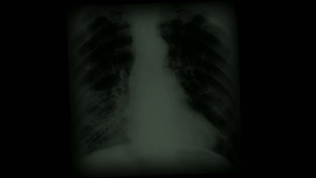 x-ray film,human skeleton,finger bone. abstract background.