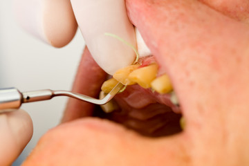 Dental cord placing in gingival sulcus