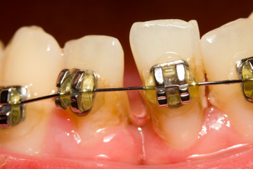 Closing of gap with dental braces