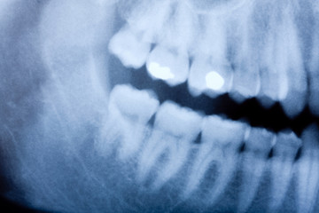 Fototapeta premium dental x-ray