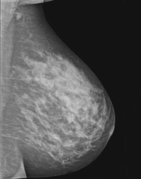Mammographie  sein