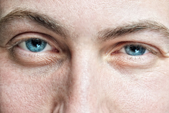 Closeup of young man's blue eyes with problematic skin
