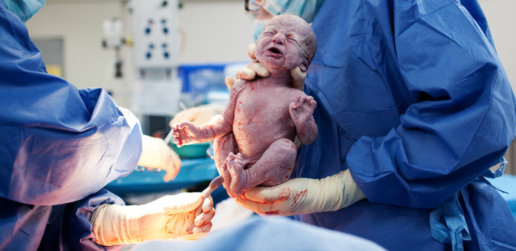 Baby being born via Caesarean Section
