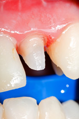 Tooth stub for dental crown