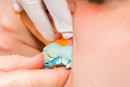 Dental imprint - dentist taking fine impression with silicone