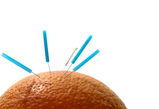 Akkupunktur - Orangenhaut