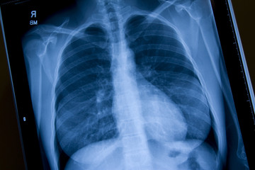 X-ray of Chest