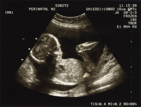 Ultrasound of a fetus at 20 weeks