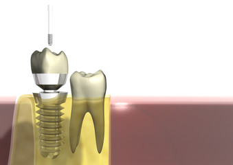ZahnImplantat