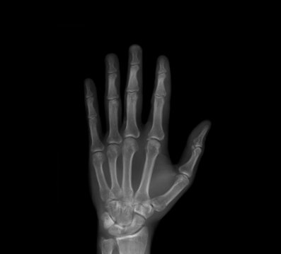 x-ray of Hand
