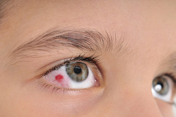 High resolution macro photo of an infected child eye