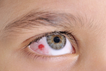 High resolution macro photo of an infected child eye