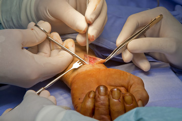 chirurgia della mano