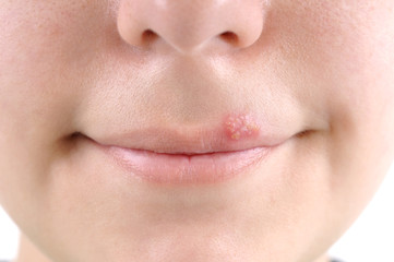 Close up of lips affected by herpes.