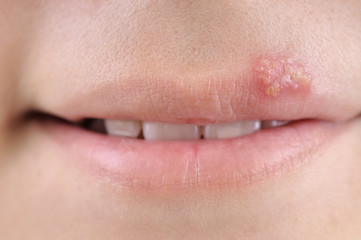 Close up of lips affected by herpes. - obrazy, fototapety, plakaty