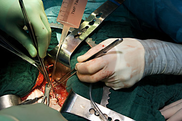 Nierentransplantation23