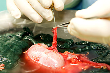 Nierentransplantation15 - obrazy, fototapety, plakaty