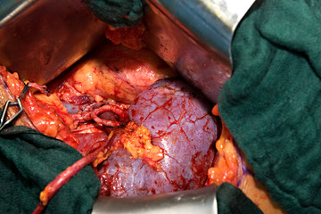 Nierentransplantation01