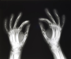 X-ray of hands pinching