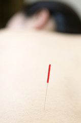 鍼治療